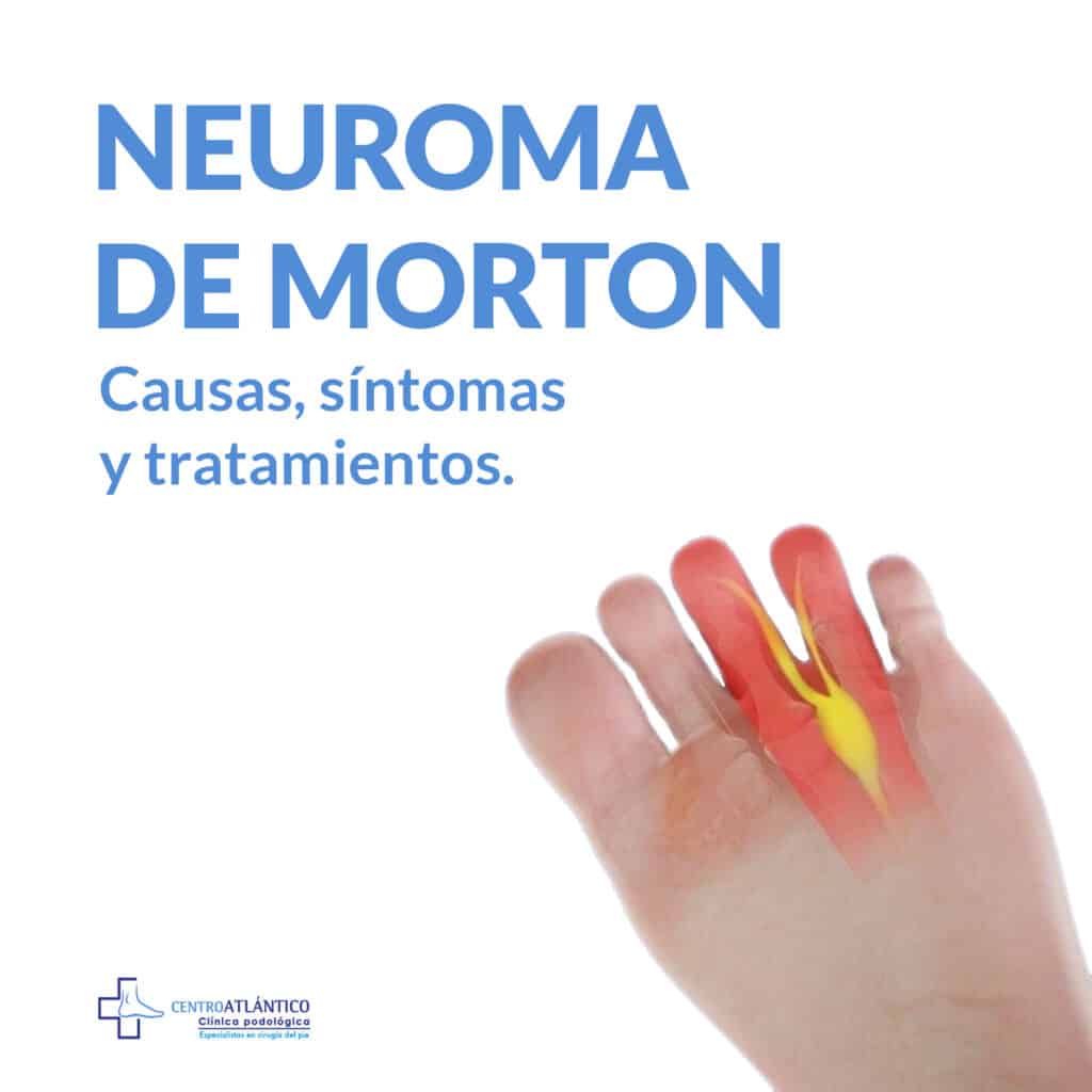 Neuroma de Morton Causas síntomas y tratamientos Centro Atlántico