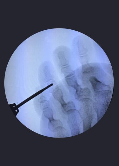 Radiografía de cirugía mínimamente invasiva del pie